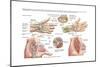 Medical Illustration Showing Carpal Tunnel Syndrome in the Human Wrist-null-Mounted Art Print