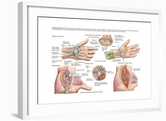 Medical Illustration Showing Carpal Tunnel Syndrome in the Human Wrist-null-Framed Art Print