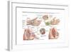 Medical Illustration Showing Carpal Tunnel Syndrome in the Human Wrist-null-Framed Art Print