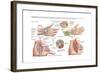 Medical Illustration Showing Carpal Tunnel Syndrome in the Human Wrist-null-Framed Art Print