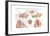 Medical Illustration Showing Carpal Tunnel Syndrome in the Human Wrist-null-Framed Art Print