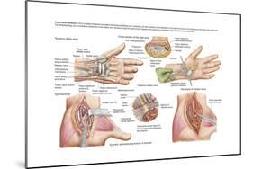 Medical Illustration Showing Carpal Tunnel Syndrome in the Human Wrist-null-Mounted Art Print