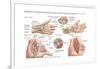 Medical Illustration Showing Carpal Tunnel Syndrome in the Human Wrist-null-Framed Art Print