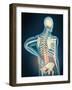 Medical Illustration Showing Inflammation in Human Back Are-null-Framed Art Print
