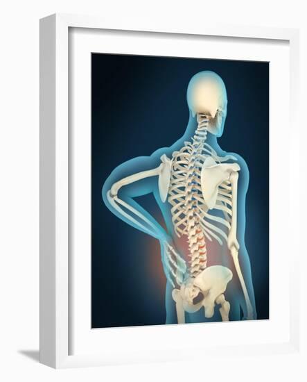 Medical Illustration Showing Inflammation in Human Back Are-null-Framed Art Print