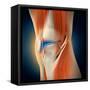 Medical Illustration Showing Inflammation in Human Knee Joint-null-Framed Stretched Canvas