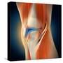 Medical Illustration Showing Inflammation in Human Knee Joint-null-Stretched Canvas