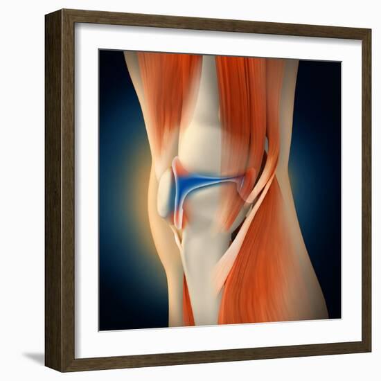 Medical Illustration Showing Inflammation in Human Knee Joint-null-Framed Art Print