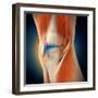 Medical Illustration Showing Inflammation in Human Knee Joint-null-Framed Art Print