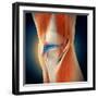 Medical Illustration Showing Inflammation in Human Knee Joint-null-Framed Art Print