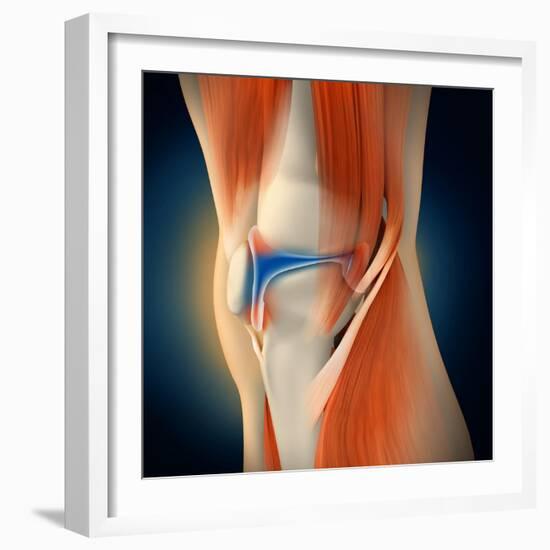 Medical Illustration Showing Inflammation in Human Knee Joint-null-Framed Art Print