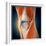 Medical Illustration Showing Inflammation in Human Knee Joint-null-Framed Art Print