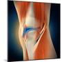 Medical Illustration Showing Inflammation in Human Knee Joint-null-Mounted Art Print