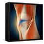 Medical Illustration Showing Inflammation in Human Knee Joint-null-Framed Stretched Canvas