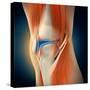 Medical Illustration Showing Inflammation in Human Knee Joint-null-Stretched Canvas