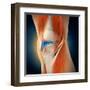 Medical Illustration Showing Inflammation in Human Knee Joint-null-Framed Art Print