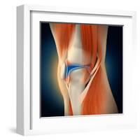 Medical Illustration Showing Inflammation in Human Knee Joint-null-Framed Art Print