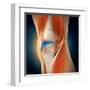 Medical Illustration Showing Inflammation in Human Knee Joint-null-Framed Art Print