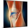 Medical Illustration Showing Inflammation in Human Knee Joint-null-Mounted Art Print