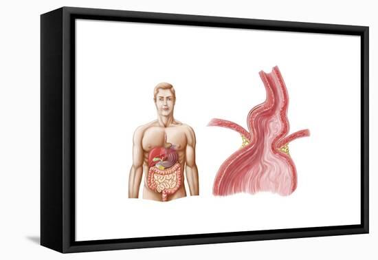 Medical Ilustration of a Hiatal Hernia in the Upper Part of the Stomach into the Thorax-null-Framed Stretched Canvas