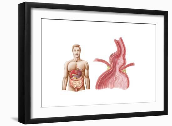 Medical Ilustration of a Hiatal Hernia in the Upper Part of the Stomach into the Thorax-null-Framed Art Print