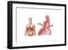 Medical Ilustration of a Hiatal Hernia in the Upper Part of the Stomach into the Thorax-null-Framed Art Print