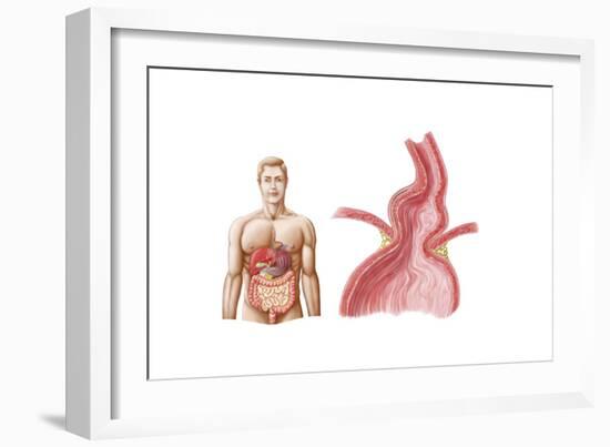 Medical Ilustration of a Hiatal Hernia in the Upper Part of the Stomach into the Thorax-null-Framed Art Print