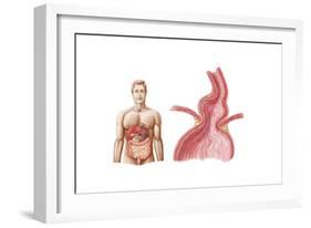 Medical Ilustration of a Hiatal Hernia in the Upper Part of the Stomach into the Thorax-null-Framed Art Print