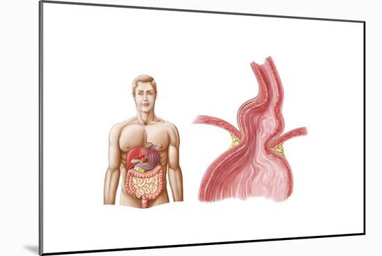 Medical Ilustration of a Hiatal Hernia in the Upper Part of the Stomach into the Thorax-null-Mounted Art Print