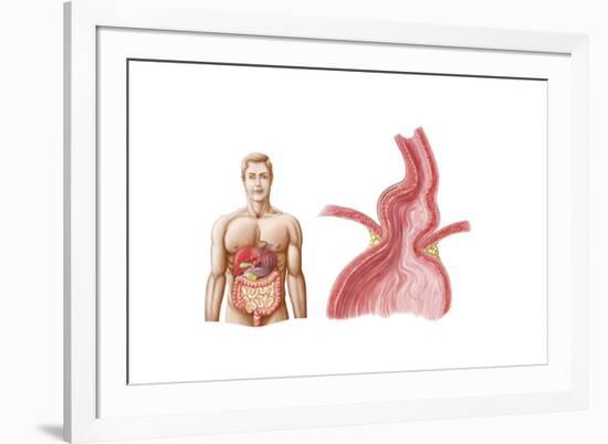 Medical Ilustration of a Hiatal Hernia in the Upper Part of the Stomach into the Thorax-null-Framed Art Print