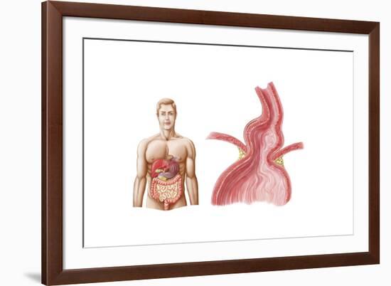 Medical Ilustration of a Hiatal Hernia in the Upper Part of the Stomach into the Thorax-null-Framed Art Print