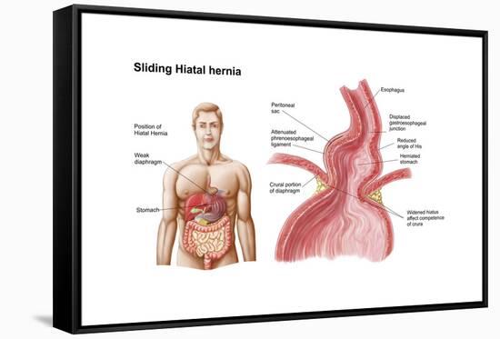 Medical Ilustration of a Hiatal Hernia in the Upper Part of the Stomach into the Thorax-null-Framed Stretched Canvas