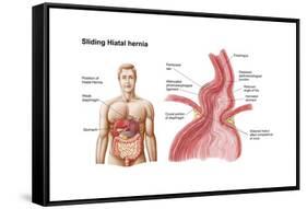 Medical Ilustration of a Hiatal Hernia in the Upper Part of the Stomach into the Thorax-null-Framed Stretched Canvas