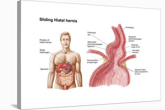 Medical Ilustration of a Hiatal Hernia in the Upper Part of the Stomach into the Thorax-null-Stretched Canvas