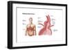 Medical Ilustration of a Hiatal Hernia in the Upper Part of the Stomach into the Thorax-null-Framed Premium Giclee Print