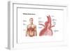 Medical Ilustration of a Hiatal Hernia in the Upper Part of the Stomach into the Thorax-null-Framed Art Print