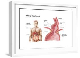 Medical Ilustration of a Hiatal Hernia in the Upper Part of the Stomach into the Thorax-null-Framed Art Print