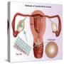 Methods of Female Birth Control-Gwen Shockey-Stretched Canvas
