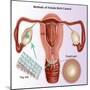 Methods of Female Birth Control-Gwen Shockey-Mounted Giclee Print