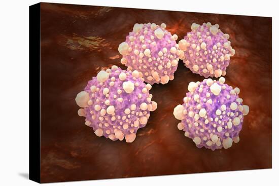 Microscipic View of Pancreatic Cancer Cells-null-Stretched Canvas