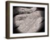 Microscopic View of Corncob Formation in Dental Plaque-null-Framed Art Print