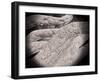 Microscopic View of Corncob Formation in Dental Plaque-null-Framed Art Print