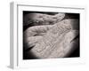 Microscopic View of Corncob Formation in Dental Plaque-null-Framed Art Print