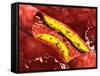 Microscopic View of Fat Plaque Inside the Artery-null-Framed Stretched Canvas