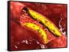 Microscopic View of Fat Plaque Inside the Artery-null-Framed Stretched Canvas