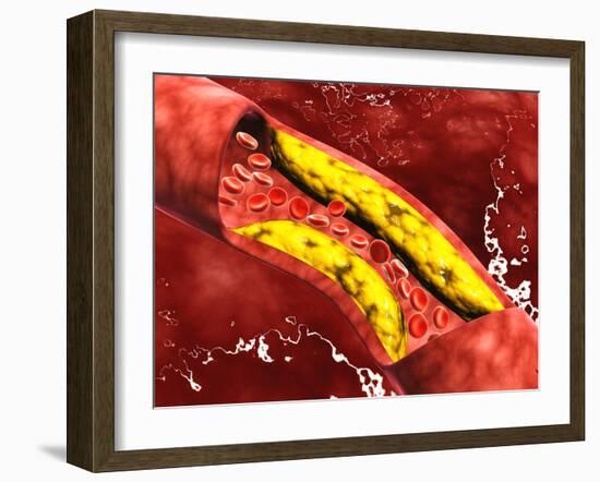 Microscopic View of Fat Plaque Inside the Artery-null-Framed Art Print