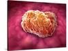 Microscopic View of Tumor-null-Stretched Canvas