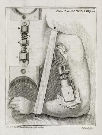 Bone-setting Mechanism, 18th Century