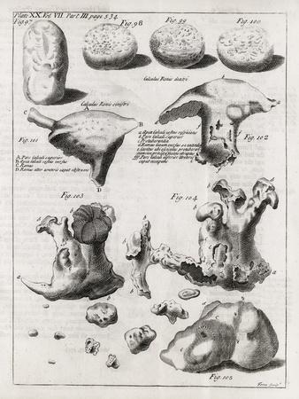 Kidney Stones, 18th Century