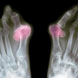 X-ray of Bunions on the Toes-Mike Devlin-Photographic Print